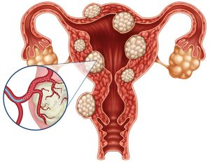 Uterine Fibroids / Pelvic Congestion at Lakeland Vascular Institute