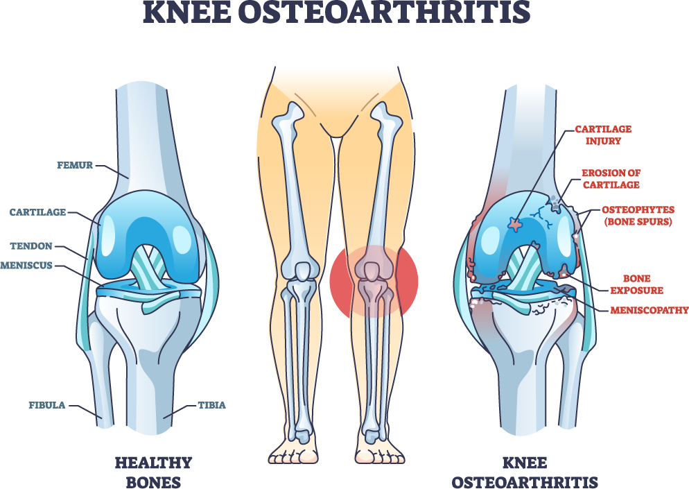 knee osteoarthritus treatment